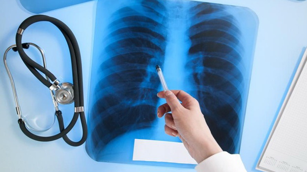 В Каменском больные туберкулезом смогут получать продуктовые наборы