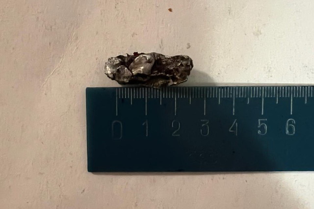 З величезним уламком у нозі дніпрянка сама дісталася лікарні